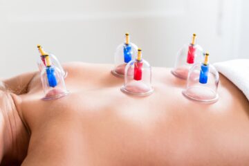 Cupping in Watford
