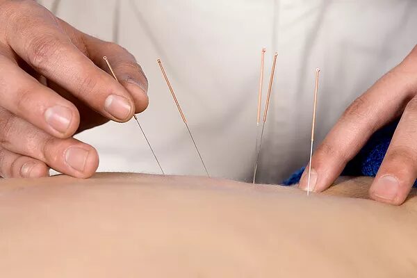 Medical Acupuncture / Dry Needling