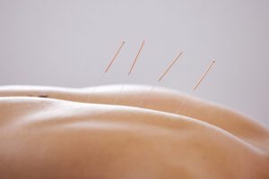 acupuncture / dry needling watford